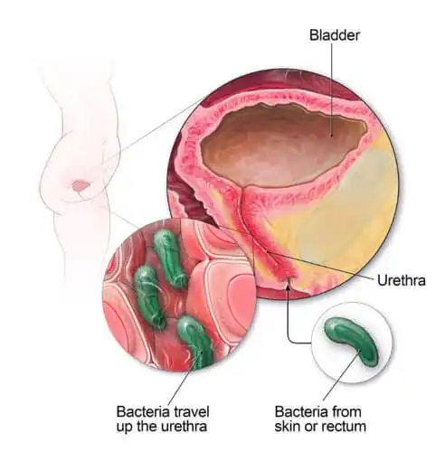 FIT-UTI-Fully-Integrated-Technology for diagnosis of Urinal Tract Infection