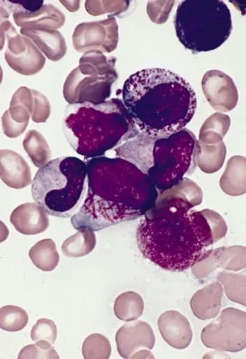 Faggot cell in acute promyelocytic leukemia